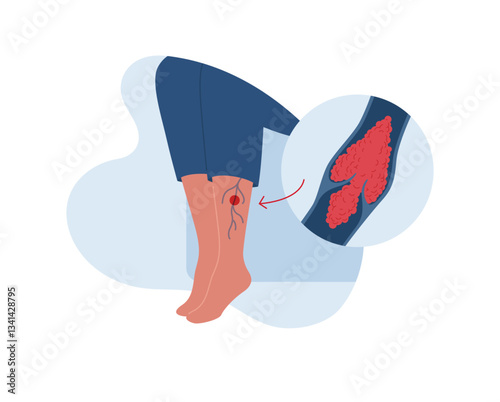 Deep vein thrombosis for healthcare infographic. Vector flat character illustration. Vascular disease diagnostic and treatment. Blood clot block vein in female leg. Design for health care, education