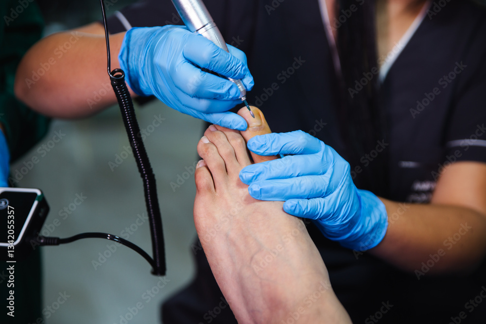 Fototapeta premium Assistant using a grinder for nail treatment on a patient in a podiatry clinic.
