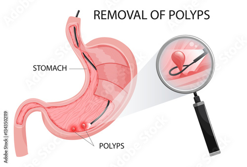 Polyp removal procedure in stomach. Polyp is under magnification. Vector illustration