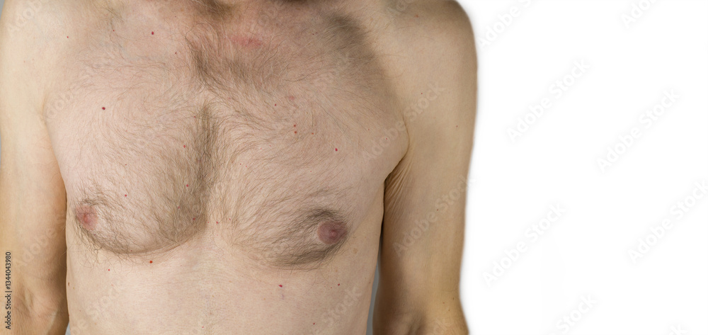 Naklejka premium Cherry angiomas skin disease. Dilated blood vessels on a mature man body