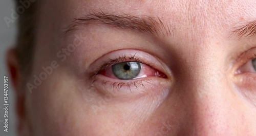 Close up of female face with one red eye suffering from infection conjunctivitis