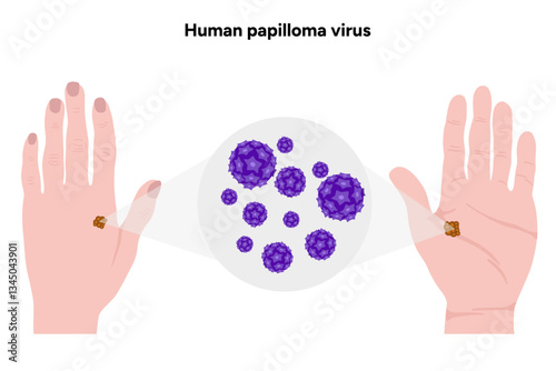 Human papilloma virus in zoom view on human hands. Hpv in human