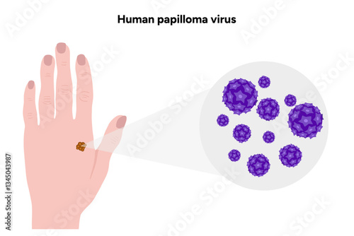 Human papilloma virus in zoom view on human hand. Hpv in human