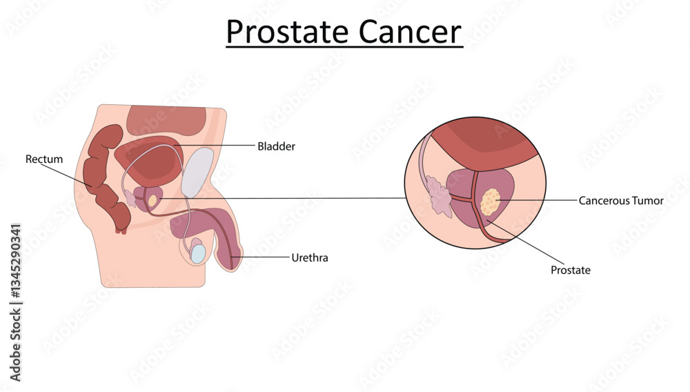 Fototapeta premium Prostate Cancer vector illustration. Male reproductive system