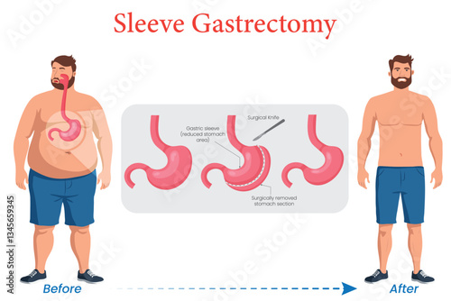 Sleeve Gastrectomy Before and After Transformation Illustrated
