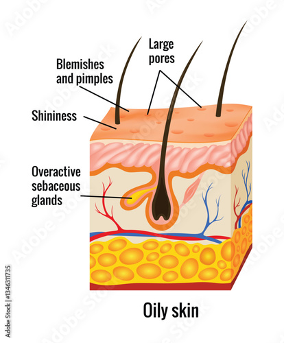 Obraz na płótnie Oily skin anatomy. Human body skin vector illustration with parts vein artery hair sweat gland epidermis dermis and hypodermis. Human Cross-section of the skin layers structure w salonie