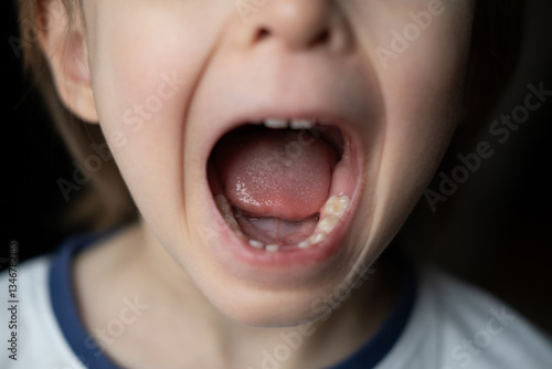 Εκτύπωση καμβά Portrait of little boy with open mouth without one front milk tooth