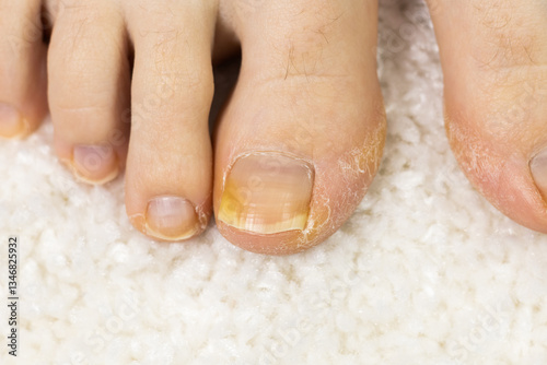 Onycholysis on the toe. Detachment of the nail from the nail bed. Podiatry problems with thick toenails. Close up human finger on foot.