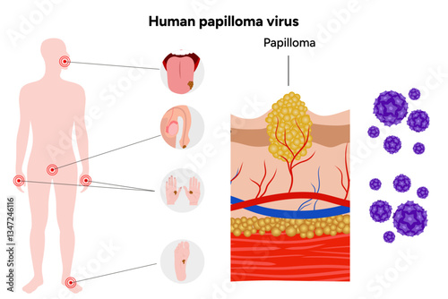 Human papillomavirus on tongue, reproductive system, hands, and feet. Medical screening illustration