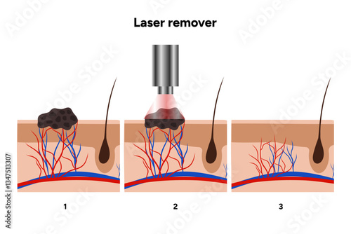 Laser remover of different types of skin lesions papillon, birthmark, mole, melanoma, keratome, hemangioma