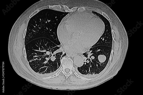 Obraz na płótnie Medical themes: CT Scan of leiomyosarcoma metastatic to the lungs w salonie