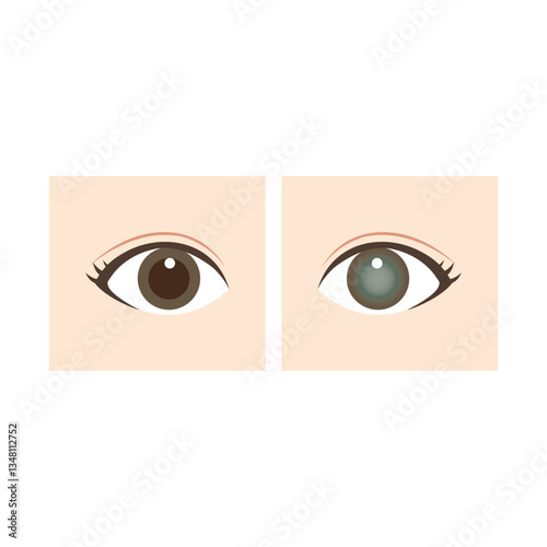 正常な目と緑内障の目の比較のイラスト