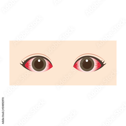 結膜炎などで激しく充血した両目