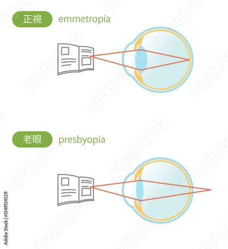 正常な眼と、老眼の眼のイラストセット