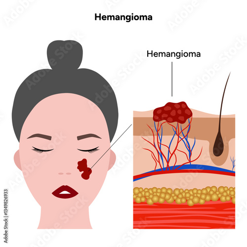 Human hemangioma skin disease microbiology. Medical screening illustration in zoom
