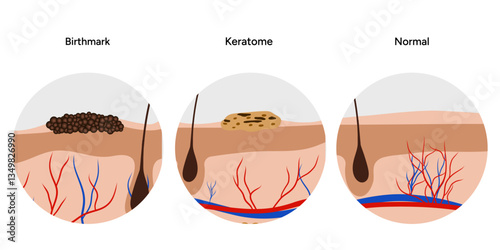 Human keratome and birthmark skin disease microbiology. Medical screening illustration in zoom