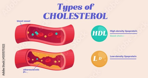 Types of cholesterol comparison. Moving banner with medical infographic with HDL and LDL lipoprotein in cross section of blood vessel. Educational diagram. Cartoon flat animated graphics