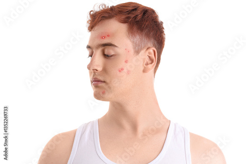 Teenage boy with acne on wh...