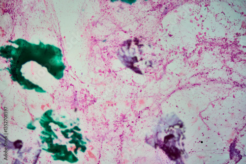 Obraz na płótnie Cytology showing squamous cell carcinoma from bronchial lavage w salonie