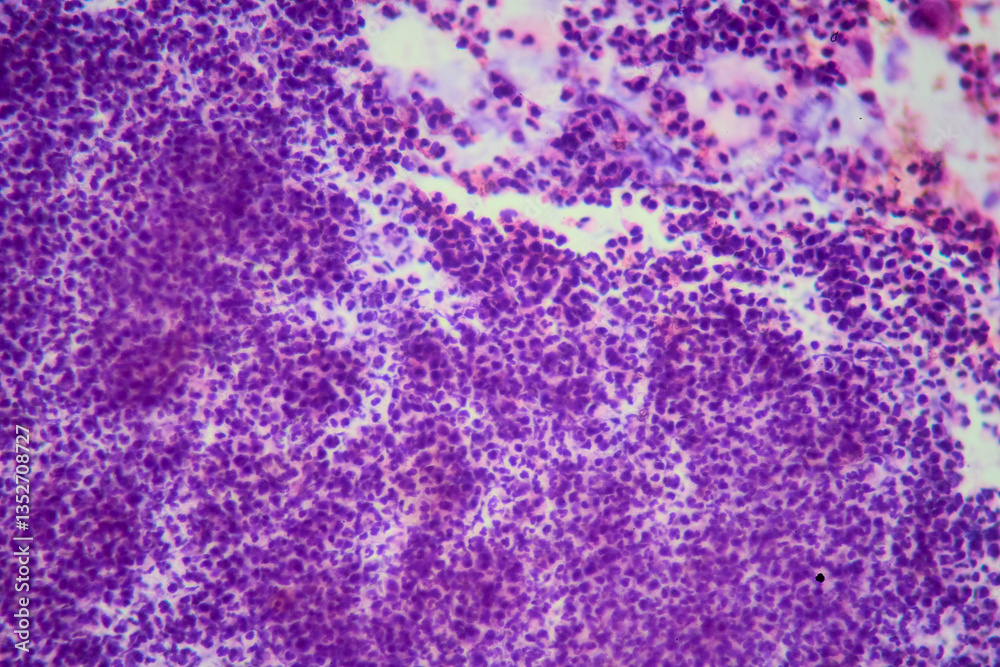 Medical themes: Bronchial lavage revealing tuberculosis granuloma and mycobacterium TB bacilos.