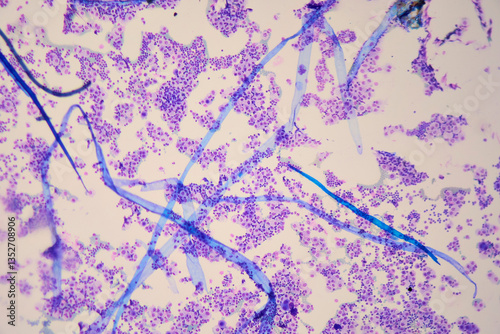 Obraz na płótnie Medical themes: Pleural effusion showing chylothorax caused by B-cell lymphoma w salonie