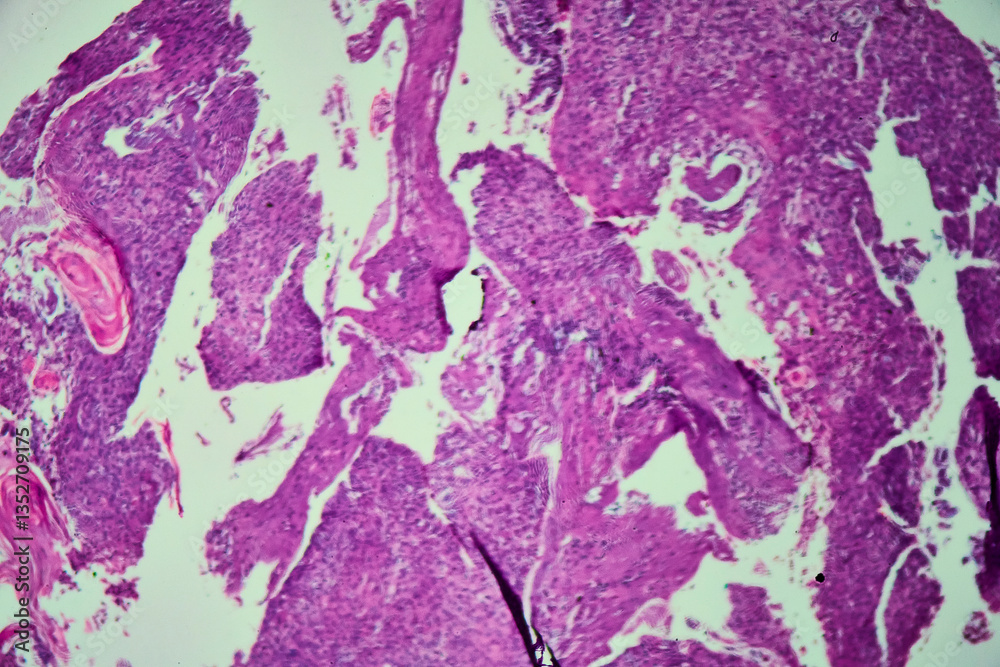 Medical themes: Bronchial biopsy showing squamous cell carcinoma