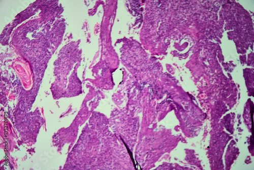 Obraz na płótnie Medical themes: Bronchial biopsy showing squamous cell carcinoma w salonie