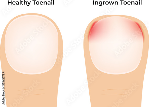 Comparison of Healthy Toenail and Ingrown Toenail