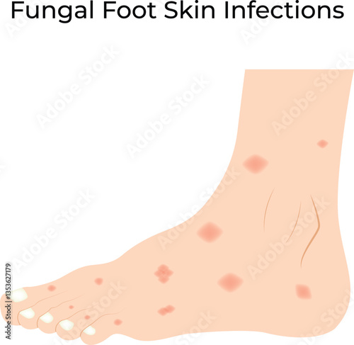 Fungal Foot Skin Infections Vector Illustration