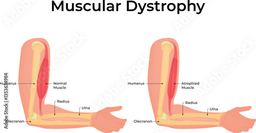 Muscular Dystrophy Arm Muscle Atrophy