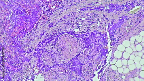 Photomicrograph of pyogenic granuloma, in digiti 3 manus dextra tumor under microscope in anatomical pathology laboratory photo