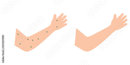 the hand of a healthy child and the hand of a child with chickenpox