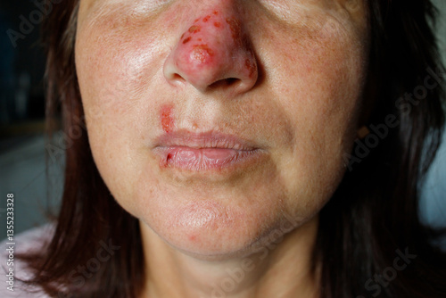 Photos Red nose with strong sores and herpes on face of woman close up