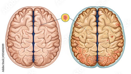 anti-amyloid Alzheimer's Testing image illustrates comparison of healthy brain and one affected by Alzheimer disease, highlighting impact of anti