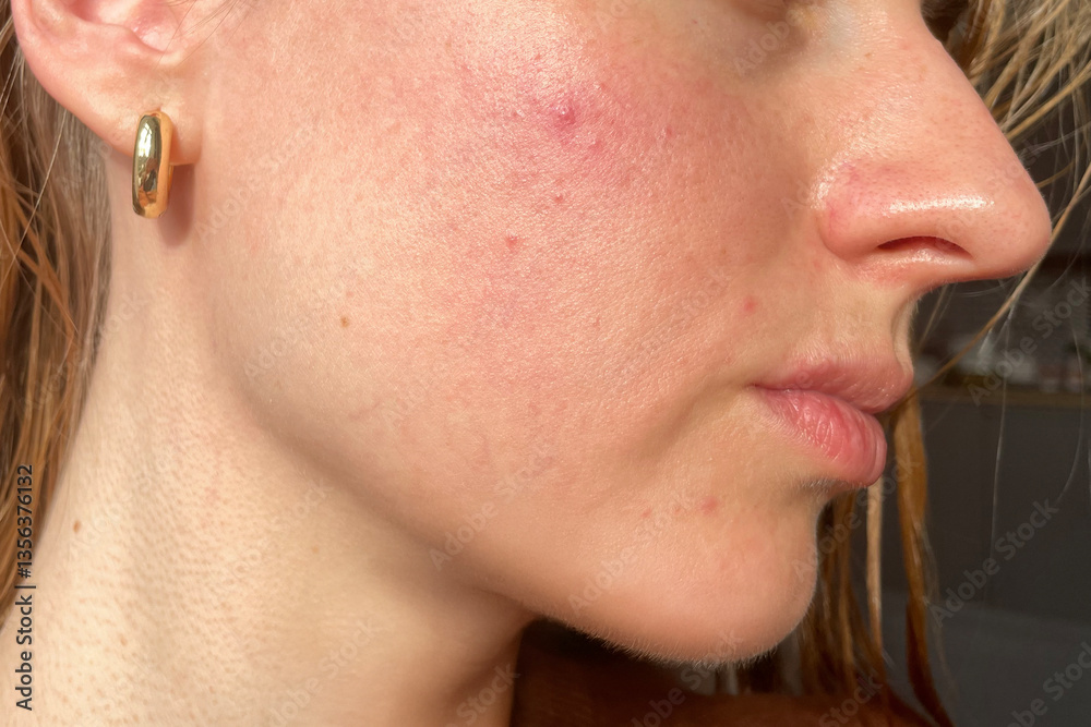 Obraz premium Close-up of a young woman's cheek with visible acne, redness, and skin irritation in natural daylight. Skincare or dermatology concept.