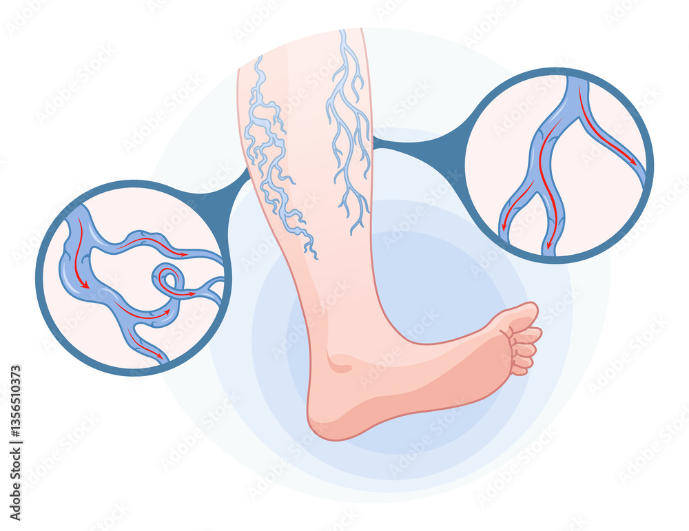 Varicose veins. Blue blood vessel visible through the skin, abnormally swollen leg. Vascular disease diagnostic and treatment. Venous insufficiency medical disease