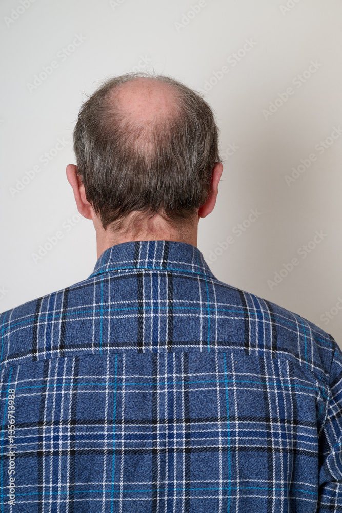 Human hair loss solution concept