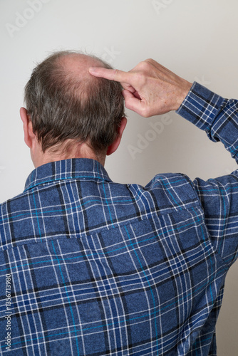 Obraz na płótnie Human hair loss solution concept w salonie