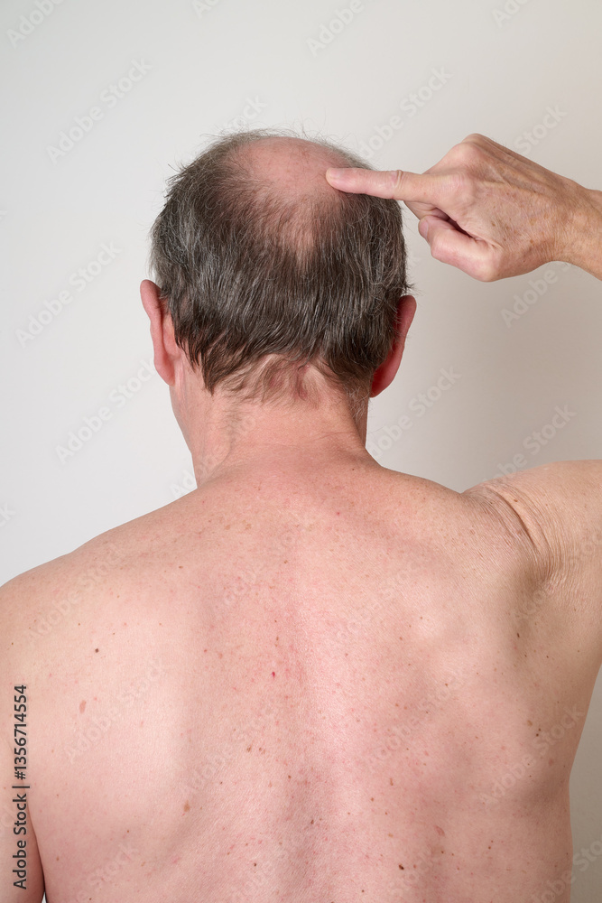 Human hair loss solution concept