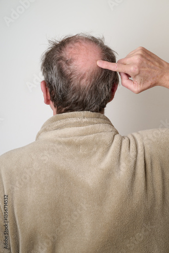 Human hair loss solution concept