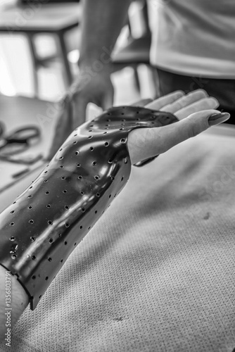 Hand splint application by a professional therapist in a modern physiotherapy center