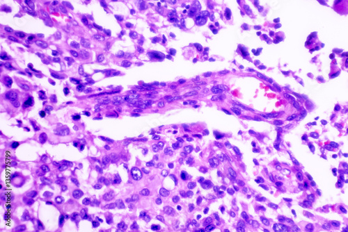 Backgrounds of human cells tissue of lung human under the microscope in pathology lab.View in microscopic of squamous cell carcinoma from human cervical cancer, tissue section by H and E