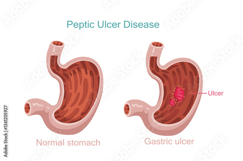 Peptic Ulcer Disease