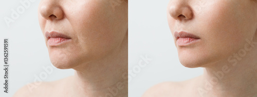 Female nasolabial fold before and after wrinkle smoothing procedures. Correction of the chin and neck shape. The result of the rejuvenation procedure at the aesthetic medicine clinic.