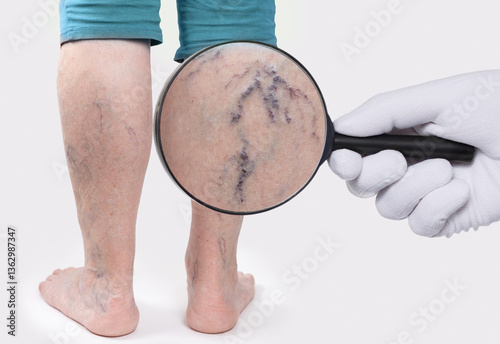 Doctor's hand in a white glove shows zoomed blood vessels with a magnifying glass. Old woman with vascular asterisks on her legs. Rear view. The concept of varicose veins.