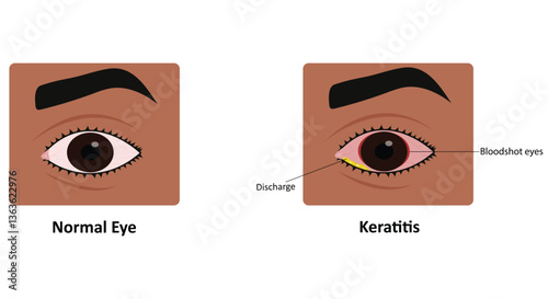 Keratitis eye disease vector illustration