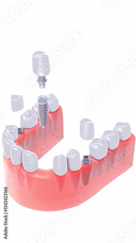 Vertical 3D animation of three dental implants being placed simultaneously in a gum. Featuring a realistic anatomical graphic style. Viewed from above with a white background.