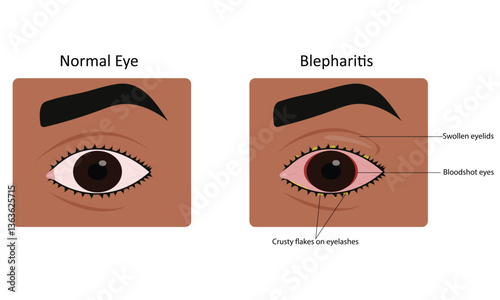 Blepharitis eye disease vector illustration
