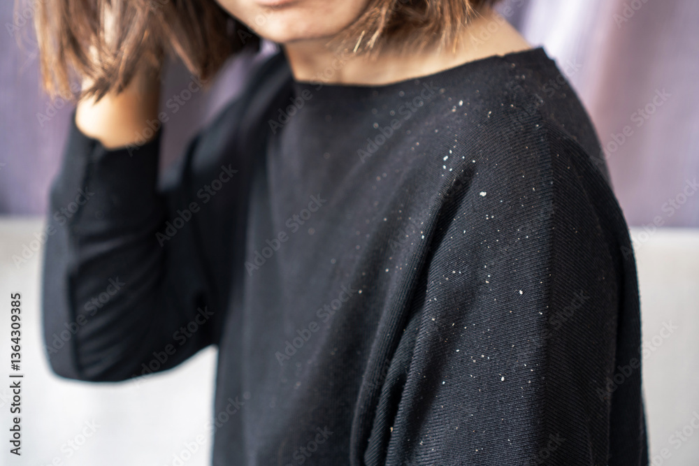 Fototapeta premium woman suffering with itchy and dry scalp, scratching her head because of dandruff and white flakes on her hair and shoulders, caused by dry skin, scalp problems, or using strong hair products