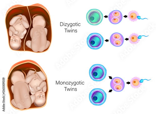 Monozygotic and Dizygotic Twins Educational Diagram. Identical vs Fraternal Twins Medical Illustration. Comparison of Twin Formation Medical Poster. Human Twins Developmental Differences Chart photo